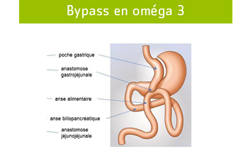 Bypass en oméga